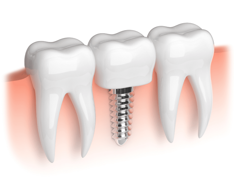 implant